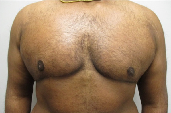 Gynecomastia Surgeru After Grade 4