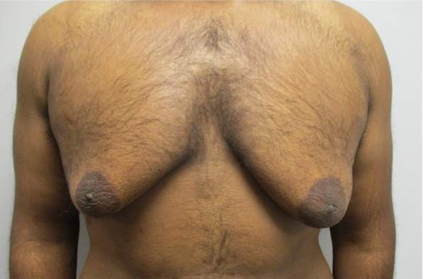 Gynecomastia Surgery Before Grade 4