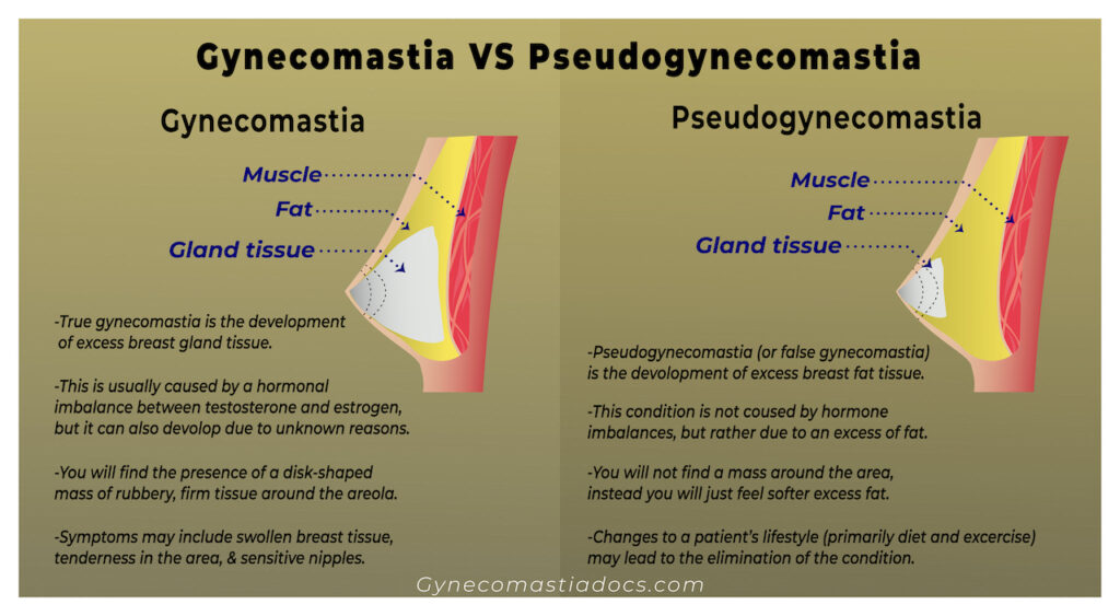 Gynecomastia vs. Chest Fat: Which One Do You Have?