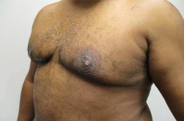 Gyno Stage 4 After Surgery