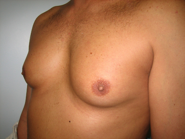 Gyno Surgery After Photo